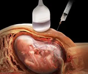 ماجرای حضور فقها در شورای جدید سقط جنین