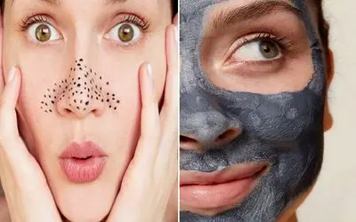 ساده ترین درمان از بین بردن جوش های سرسیاه بینی؛ فقط با یه بار استفاده از وازلین