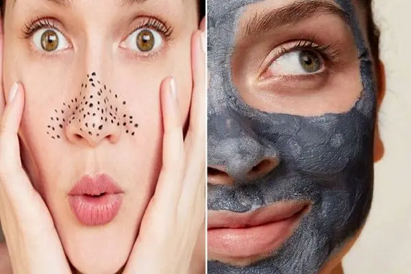 ساده ترین درمان از بین بردن جوش های سرسیاه بینی؛ فقط با یه بار استفاده از وازلین