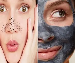 ساده ترین درمان از بین بردن جوش های سرسیاه بینی؛ فقط با یه بار استفاده از وازلین