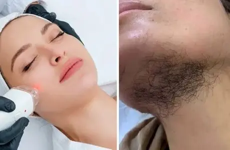 میخوای موی صورتتو لیزر کنی ولی نمیدونی محو میشه یا بیشتر؟ راهنمای تشخیص پشمالو نشدن