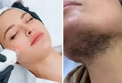 میخوای موی صورتتو لیزر کنی ولی نمیدونی محو میشه یا بیشتر؟ راهنمای تشخیص پشمالو نشدن