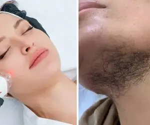 میخوای موی صورتتو لیزر کنی ولی نمیدونی محو میشه یا بیشتر؟ راهنمای تشخیص پشمالو نشدن