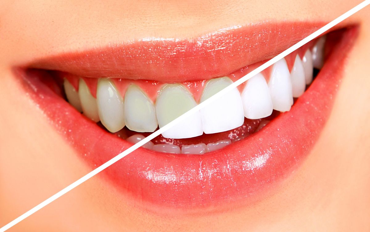 teeth-whitening-min