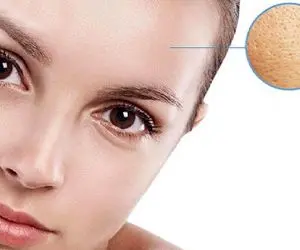 6 راز مهم خونگی درمان پوست پرتقالی؛ خلاصی از شر منافذ باز پوست یک بار برای همیشه خداحافظی کن!