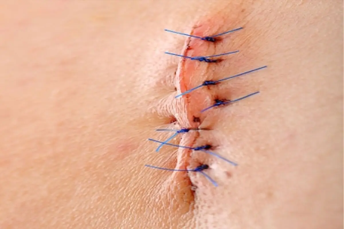 wash-suture-site-03