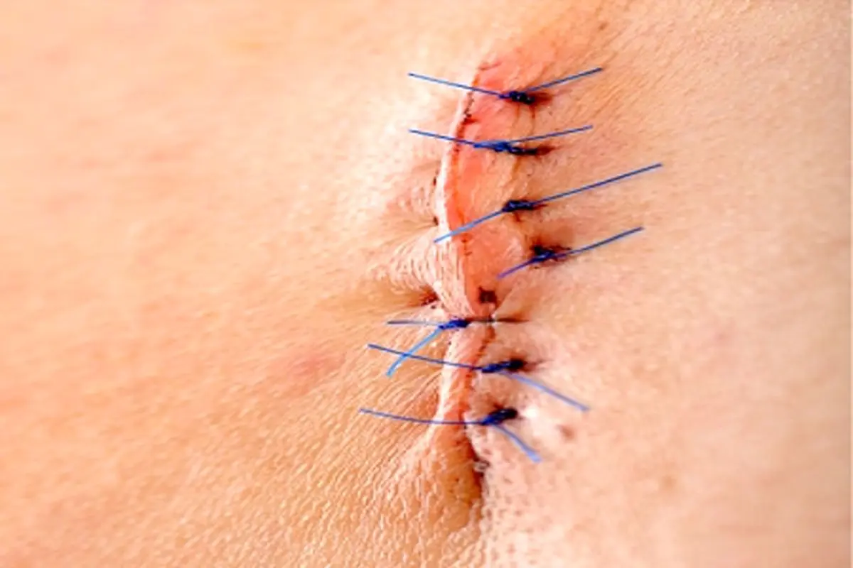 wash-suture-site-03