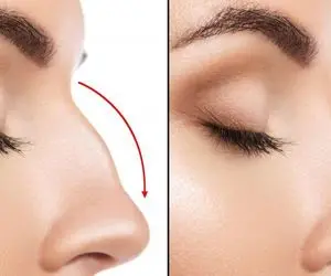 با ارزان‌ترین و بهترین کشورها در زمینه جراحی بینی آشنا شوید