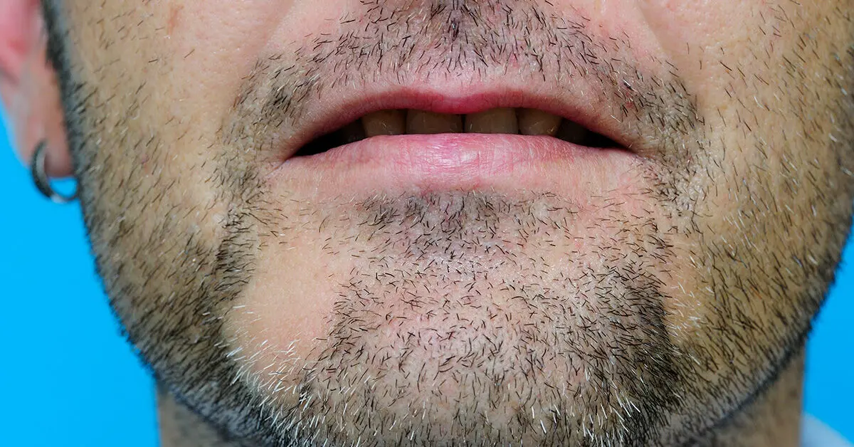 Alopecia_Areata_Beard-1200x628-Facebook