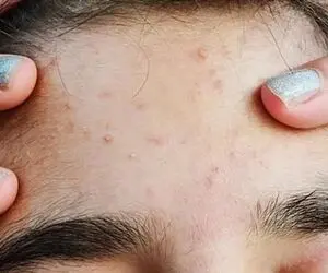 آیا جوش صورت نشانه بارداری است؟