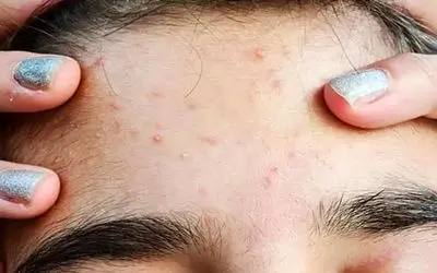 آیا جوش صورت نشانه بارداری است؟