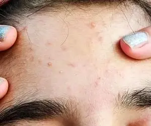 آیا جوش صورت نشانه بارداری است؟