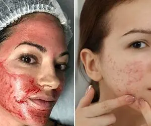 محبوب ترین روش های ازبین بردن جای جوش؛ فرورفتگی و چال نشدن پوست به شکل دائمی