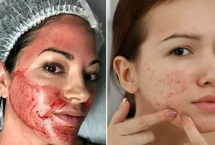 محبوب ترین روش های ازبین بردن جای جوش؛ فرورفتگی و چال نشدن پوست به شکل دائمی