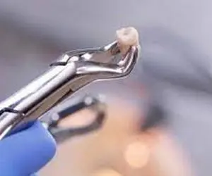 دیگر دندان های کشیده شده را دور نریزید! / عجایب فضای مجازی هر دندان ۲۰۰ هزار تومان!