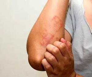 قارچ پوستی چیست؟ راه های درمان دارویی و خانگی آن
