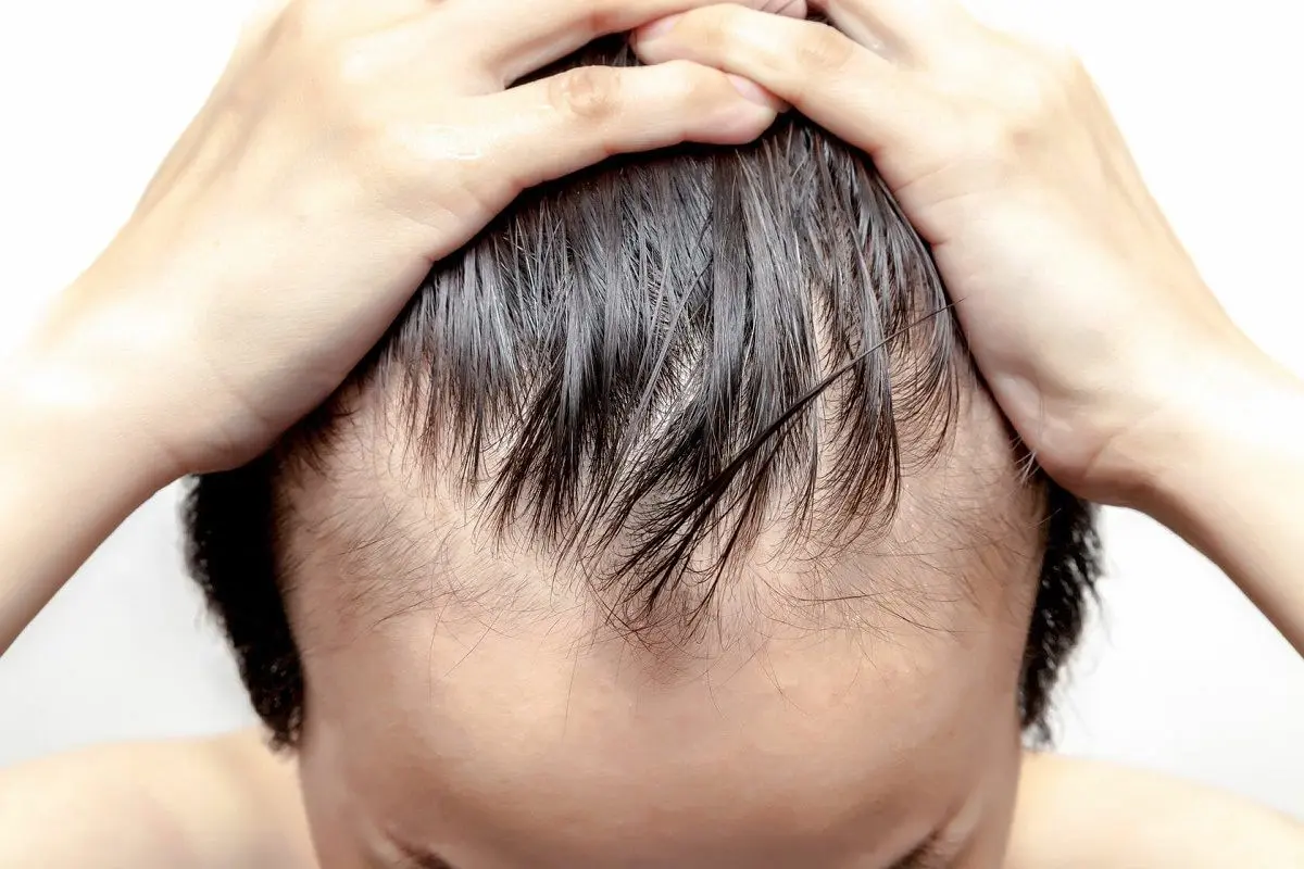 oily-scalp
