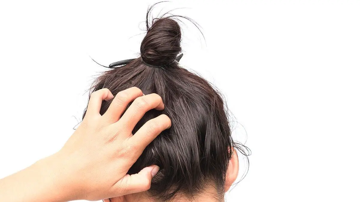 Itchy-Scalp-cuase-lice-head
