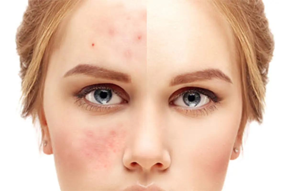 hives-on-the-face