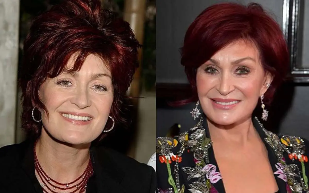 sharon-osbourne-plastic-surgery-21061
