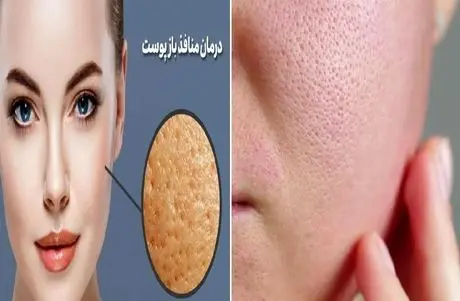 درمان خانگی منافذ باز پوست صورت با خاک رس؛ پوست پرتقالی رو تبدیل کن به آینه ی صیقلی