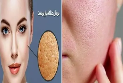 درمان خانگی منافذ باز پوست صورت با خاک رس؛ پوست پرتقالی رو تبدیل کن به آینه ی صیقلی