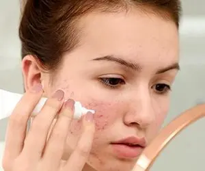 از بین بردن جای جوش و آکنه برات کابوس شده؟ بیا که چندتا ترفند ساده گفتم باورت نمیشه