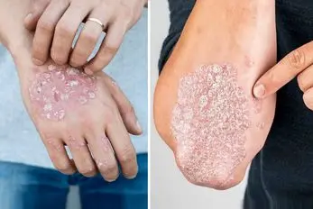 پسوریازیس بیماری که شوخی بردار نیست! اگر این علائم رو داری سریع به پزشک مراجعه کن