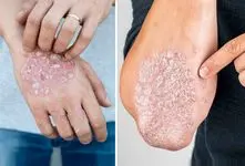 پسوریازیس بیماری که شوخی بردار نیست! اگر این علائم رو داری سریع به پزشک مراجعه کن