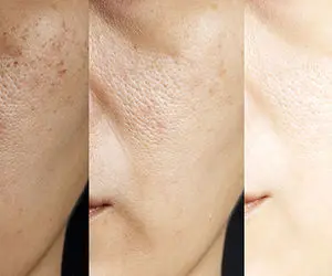 بهترین کرم ها برای بستن منافذ باز پوست و روشن کننده / چی خوبه، چی واقعاً جواب میده؟