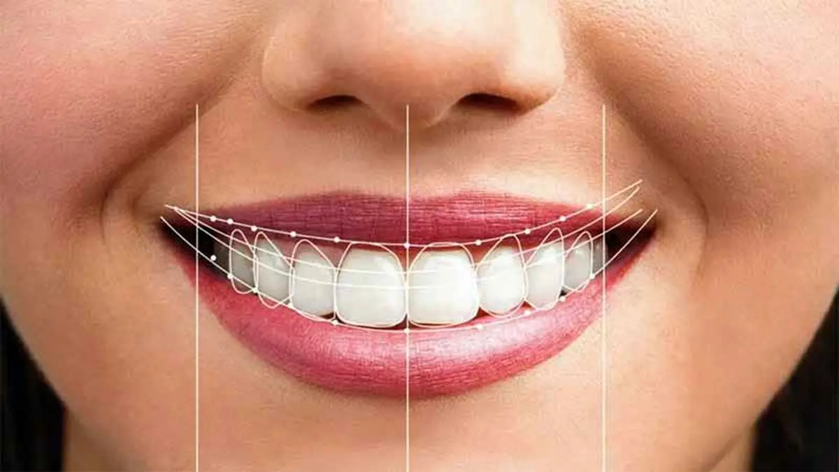 کامپوزیت-دندان-بهتر-است-یا-لمینت-سرامیکی؟