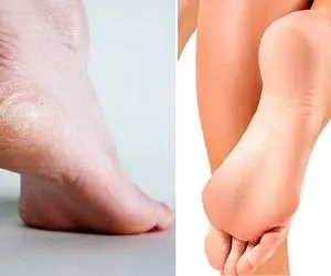 از ترک کف پاهات کلافه شدی؟ / بیا تا بهت بگم راهای جلوگیری و درمان خونگی و راحتش چیه